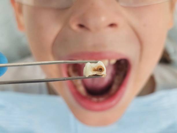 Best Emergency Treatment for Dental Infections or Abscesses in Galena, KS